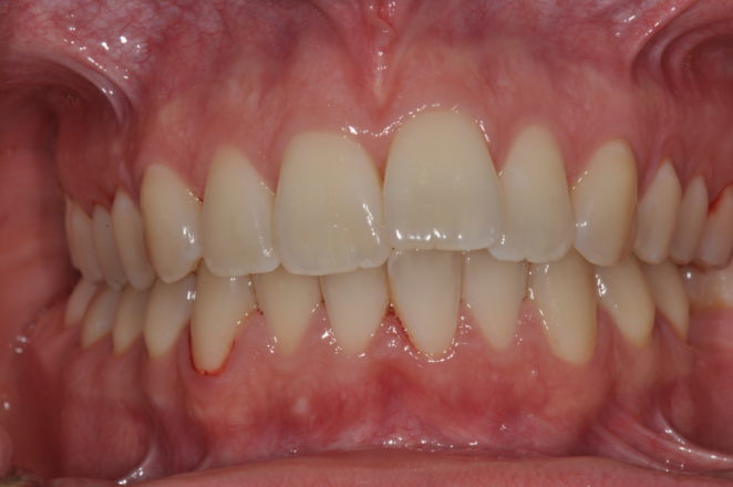 Alignement dentaire : Invasilign