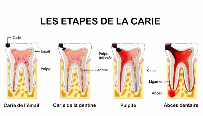 Les étapes de la carie