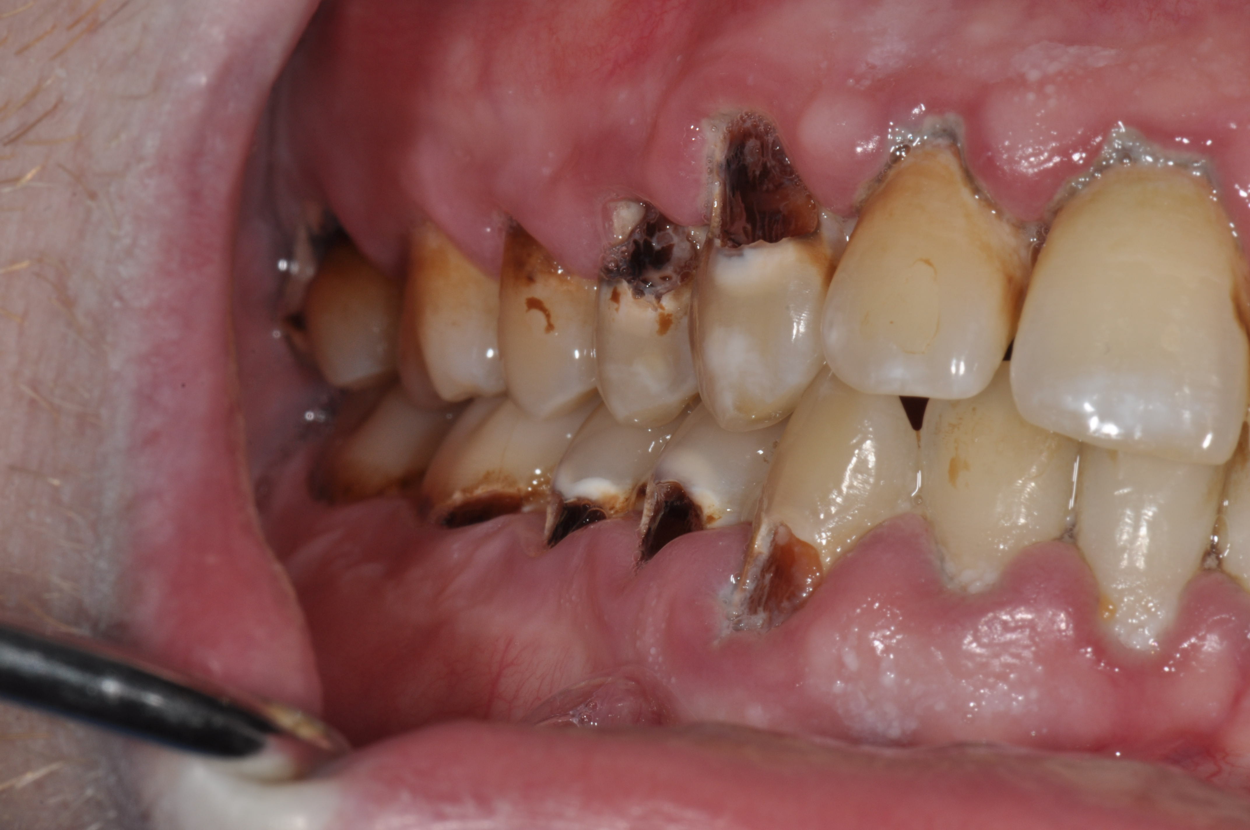 Erosion dentaire
